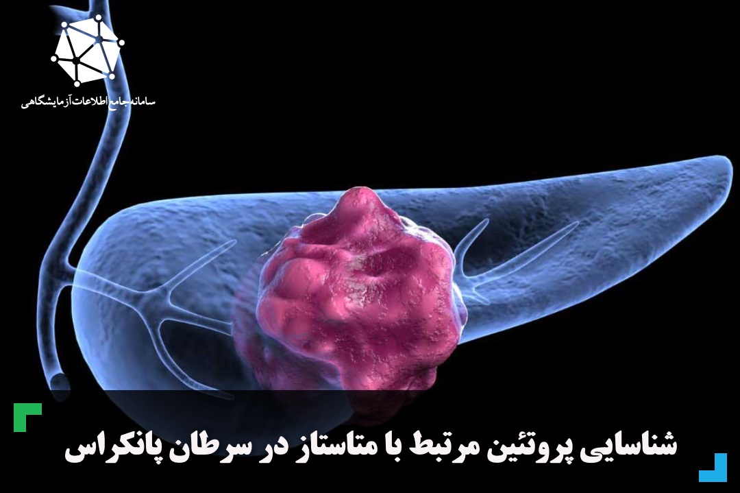 شناسایی پروتئین مرتبط با متاستاز در سرطان پانکراس