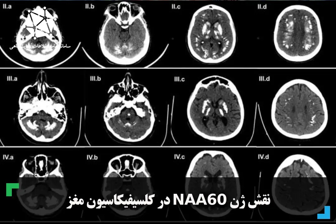 نقش ژن NAA60 در کلسیفیکاسیون مغز